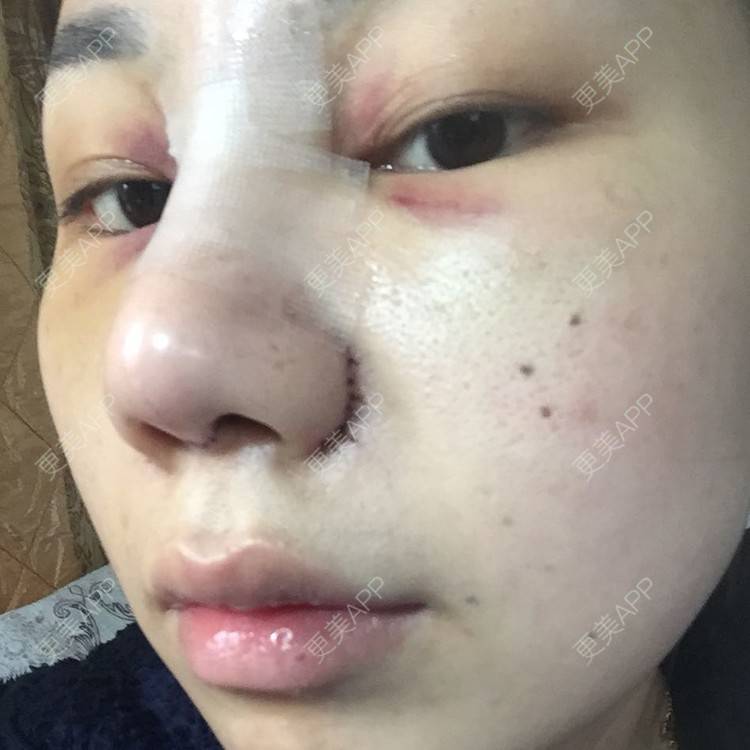 耳软骨垫鼻尖鼻翼缩小硅胶隆鼻鼻综合整形的日记