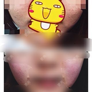 像素激光多少钱一次