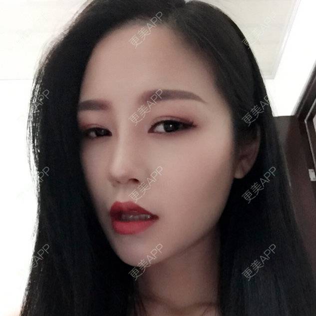 鼻小柱延长 手术缩鼻头 自体软骨垫鼻尖 硅胶隆鼻 美购日记