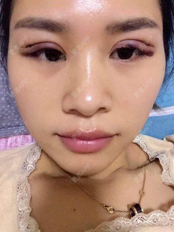 更美用户asopwguohy的埋线双眼皮日记