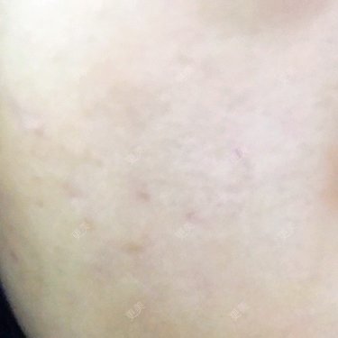 像素激光多少钱一次