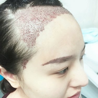 植发际线前后对比图_龙梅子整形分享_更美