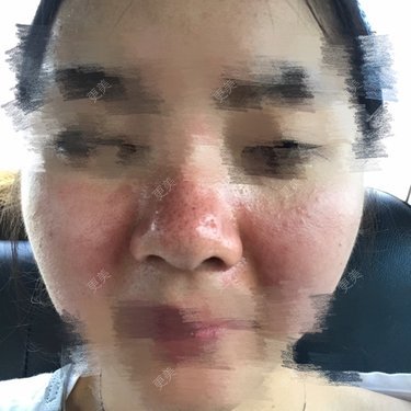 像素激光多少钱一次