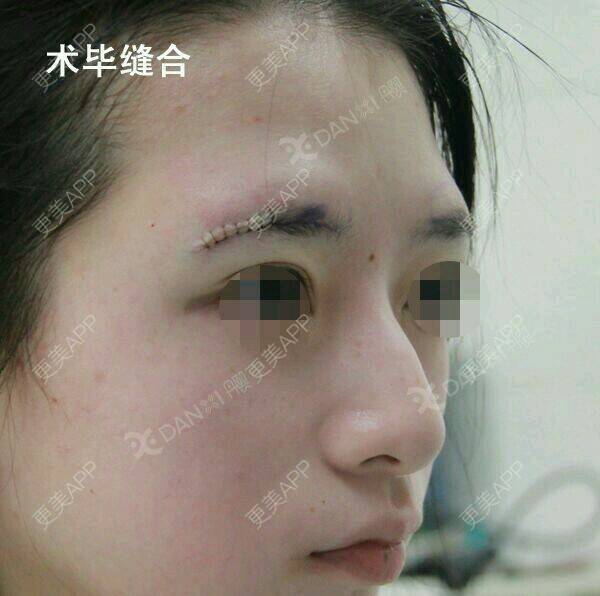 膨体垫眉弓效果图_罗汇东 医生膨体垫眉弓效果图_术后19天__更美