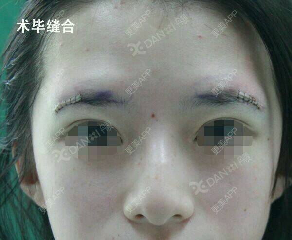 膨体垫眉弓效果图_罗汇东 医生膨体垫眉弓效果图_术后19天__更美