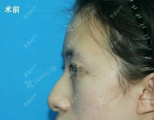 膨体垫眉弓效果图_罗汇东 医生膨体垫眉弓效果图_术后19天__更美