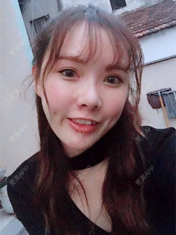 酒窝手术_更美整形