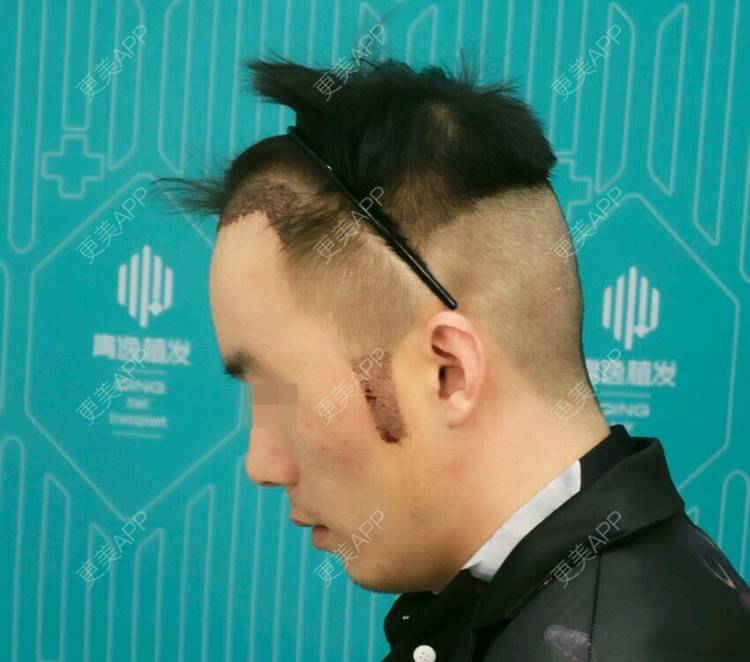 更美用户9oli6tozfm的鬓角植发日记