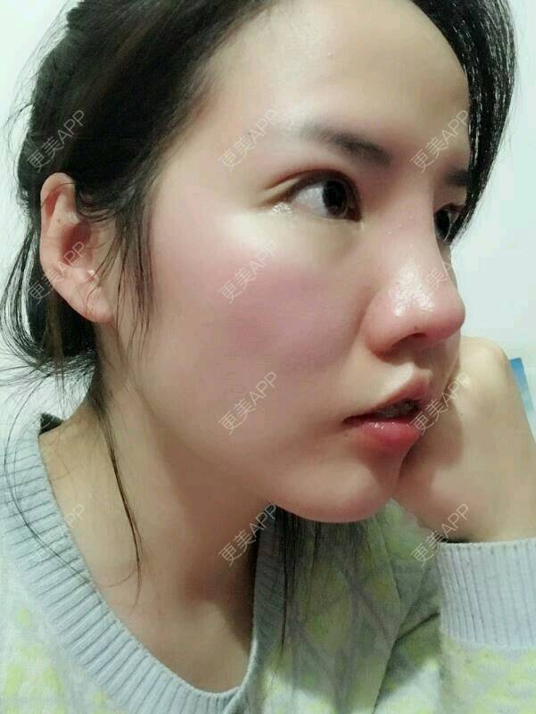 歪嘴女生的隆鼻日记