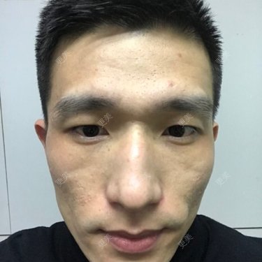 像素激光多少钱一次