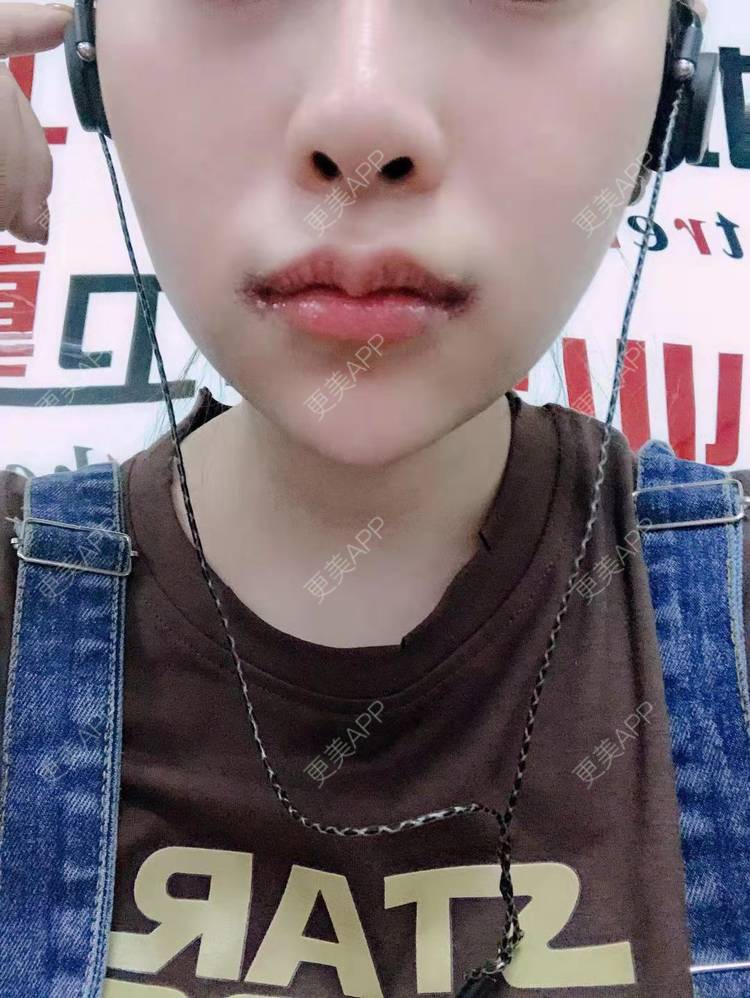 唇齿之间 演绎唇情诱惑 蚌埠一院蚌埠$22000起【m唇成形术】【唇珠