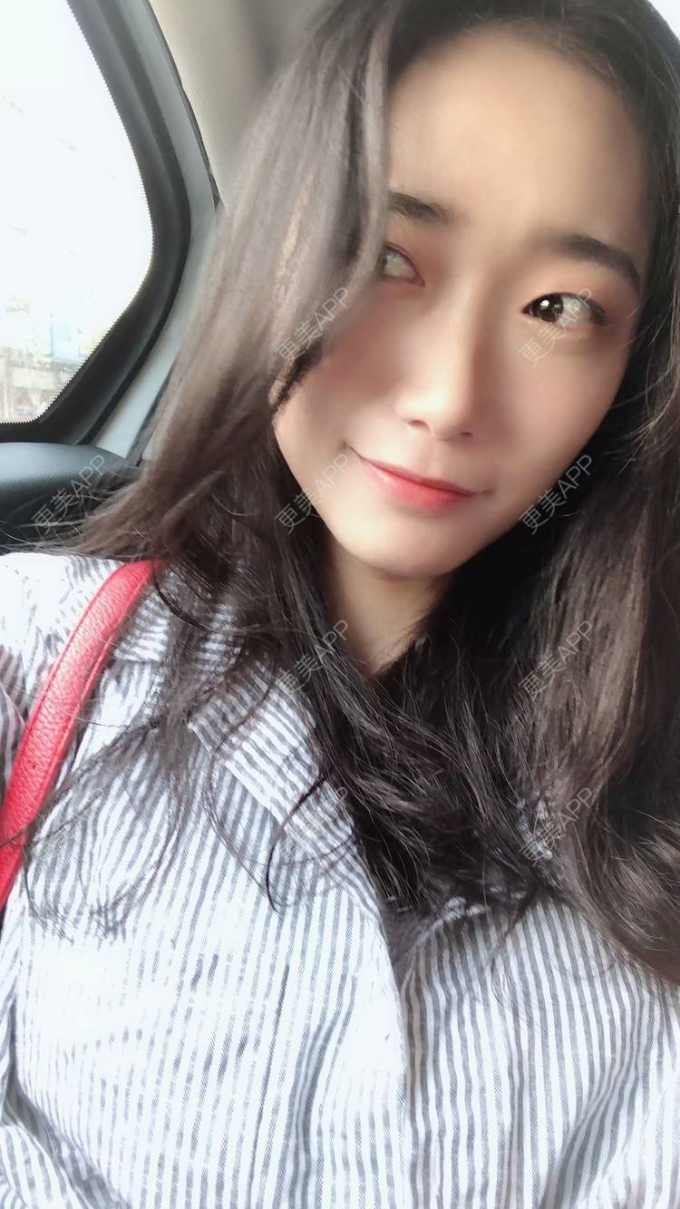 更美 更美用户vkyldyf3q0的玻尿酸日记 玻尿