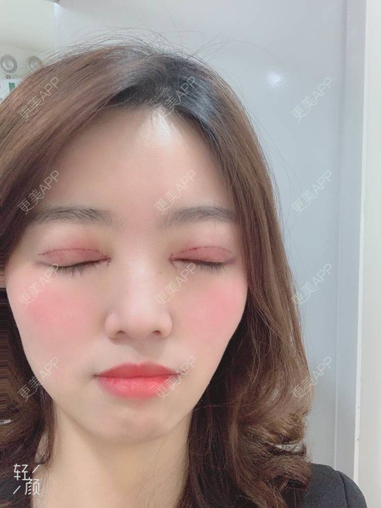 王兜兜兜兜的全切双眼皮日记