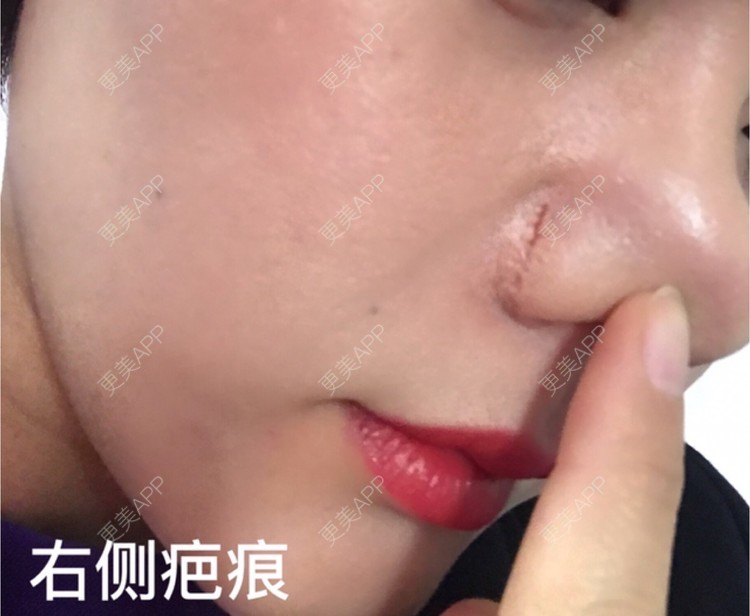 更美用户soo0a7ykbh的鼻翼缩小日记