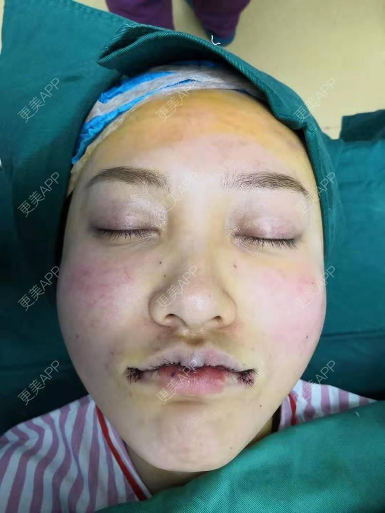 分享到:m唇成形术对比图推荐商品【m唇成形术】上唇弓塑形 上唇珠成型