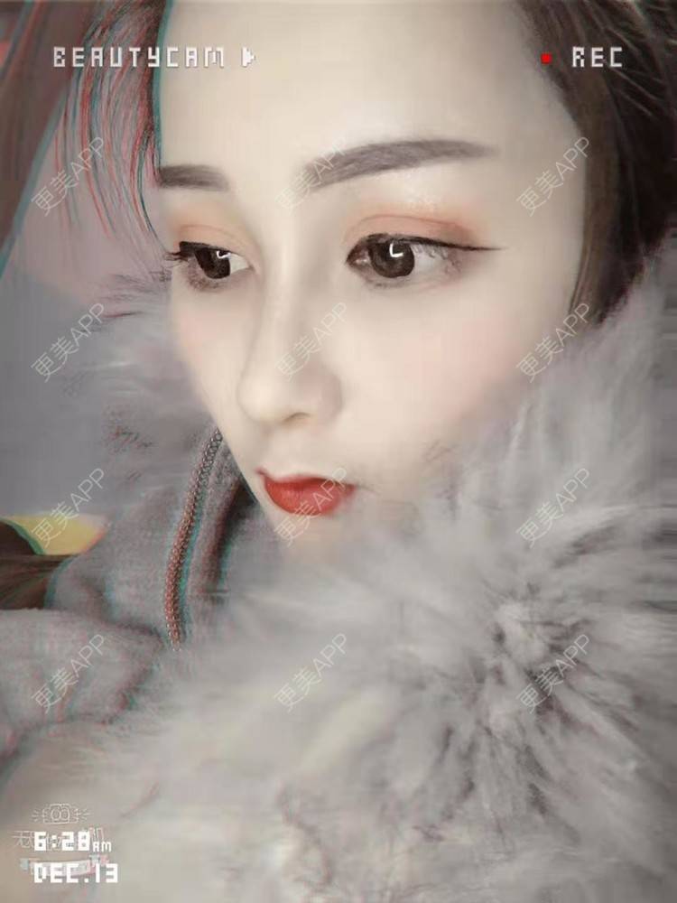 鼻综合,鼻综合对比图_多芒小葫芦鼻综合对比图_术后152天__更美