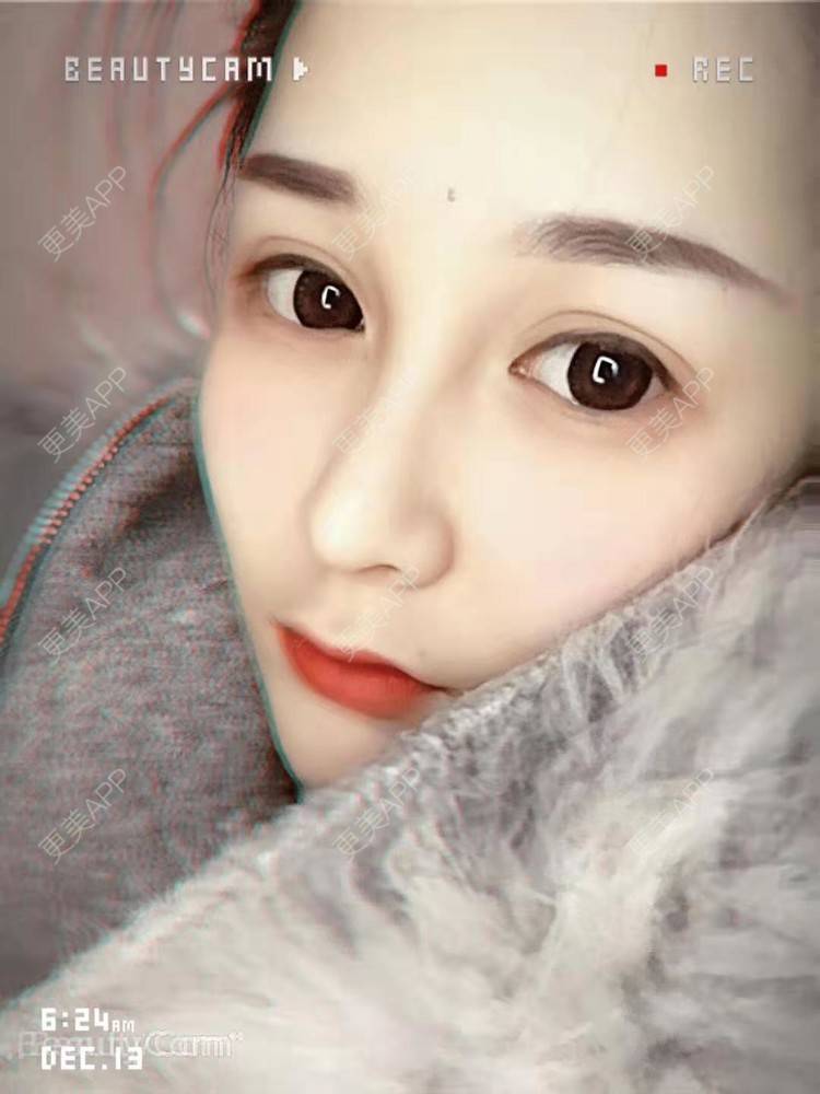 鼻综合,鼻综合对比图_多芒小葫芦鼻综合对比图_术后152天__更美