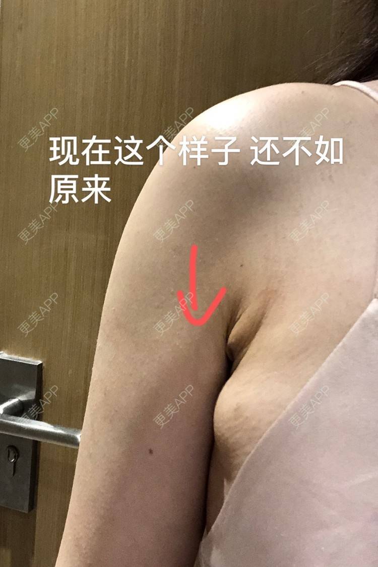 幼熙baby的吸脂去副乳日记