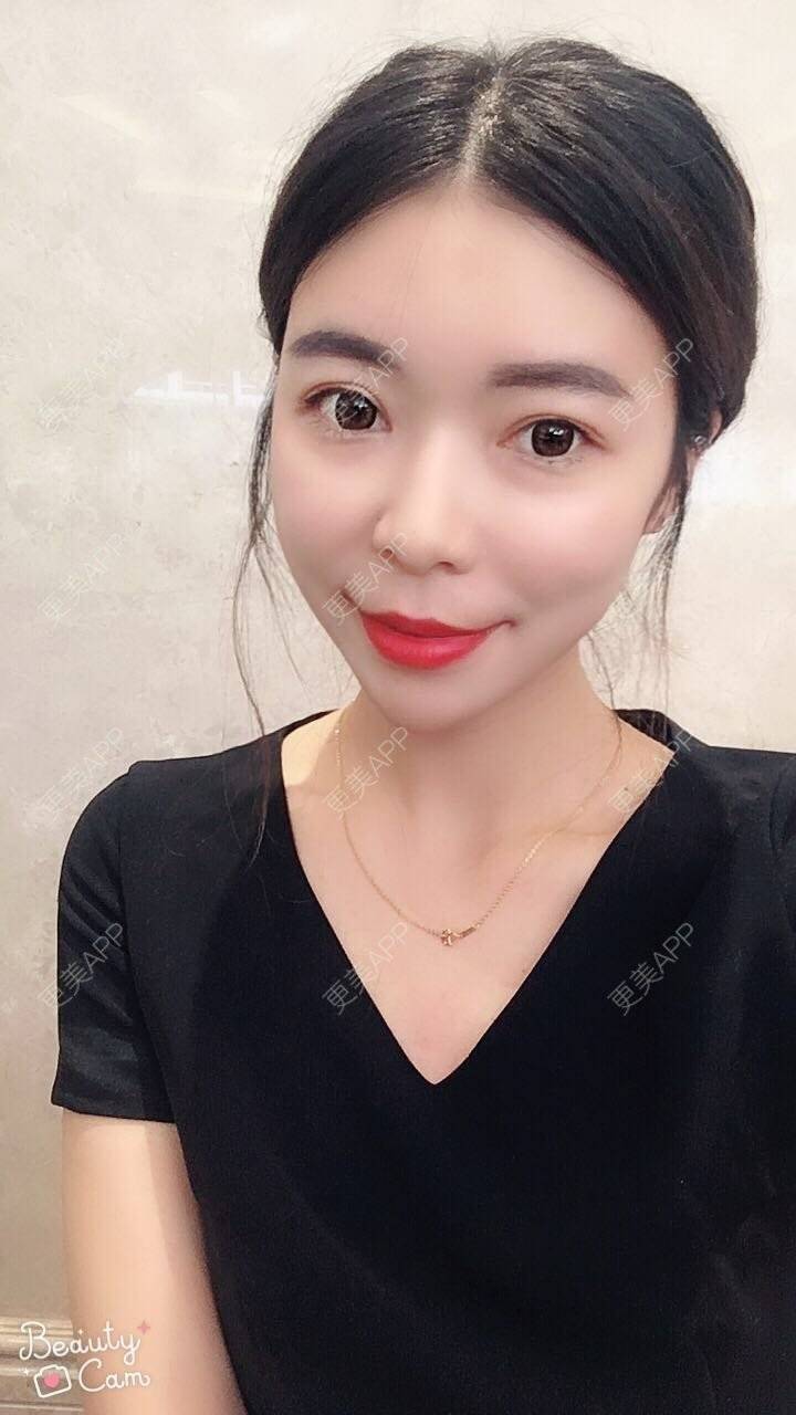 巧巧姐的自体脂肪全面部填充日记