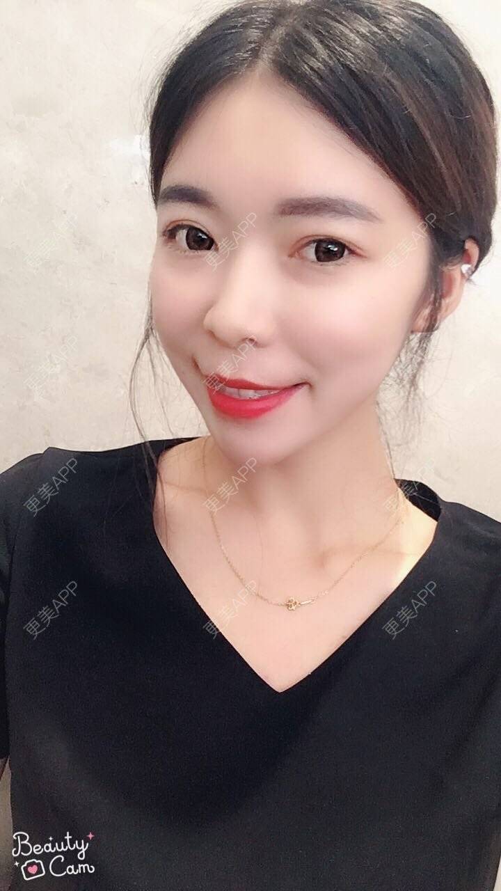 巧巧姐的自体脂肪全面部填充日记