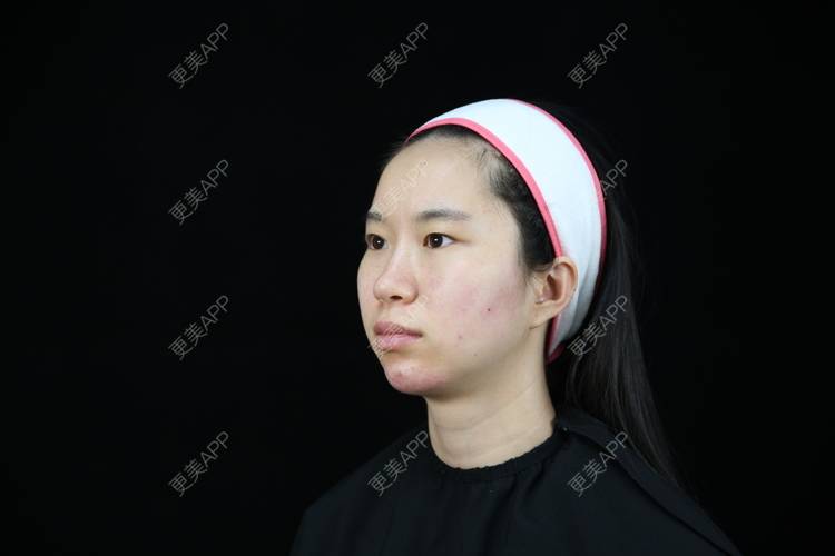 孤影不多就我一个鹿的玻尿酸下巴日记