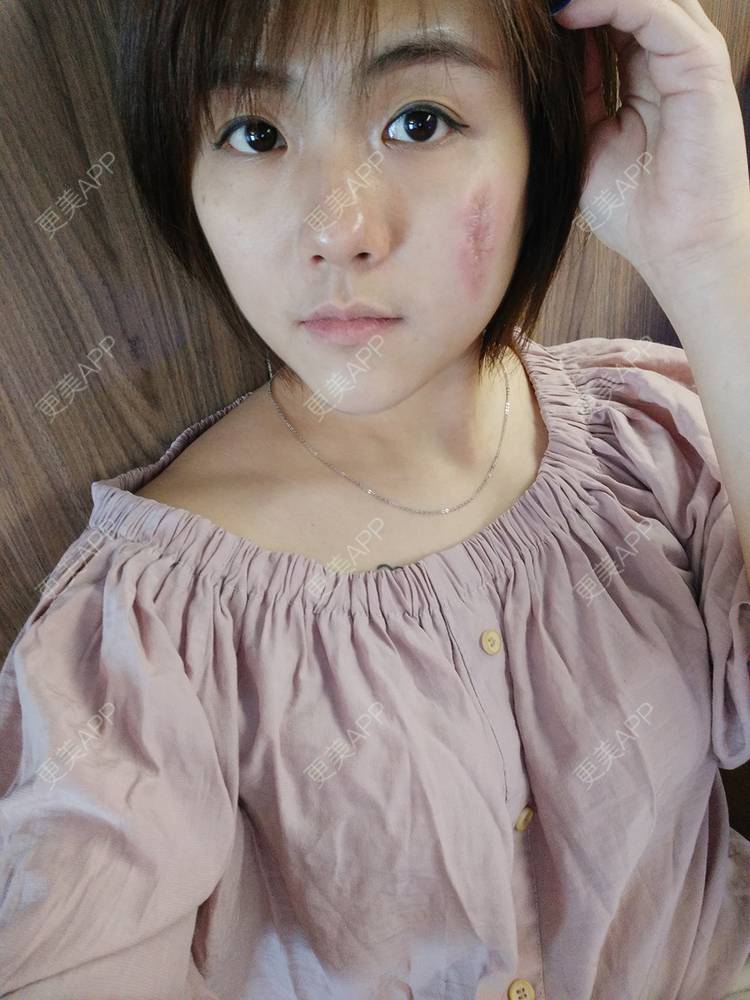 更美 七年七月七日晴的点阵激光日记 综合淡疤 手术淡疤 激光