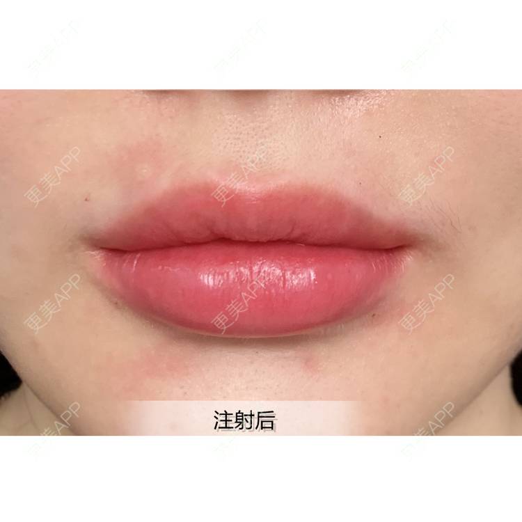更美用户pt5wbr8a6t的玻尿酸丰唇日记
