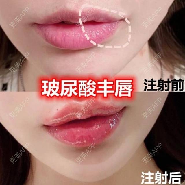玻尿酸丰唇效果图_更美用户bbzgo6k7s2玻尿酸丰唇效果图_更美