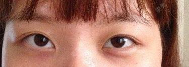 双眼皮