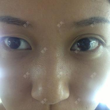 双眼皮