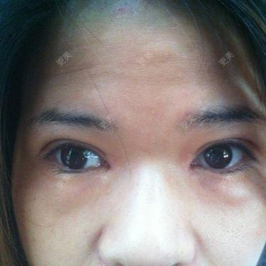 双眼皮