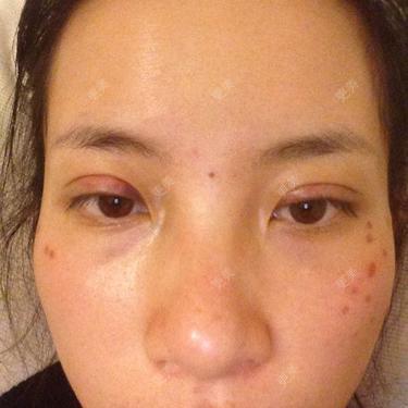 医生我做了双眼皮小切口今天第四天眼睛肿的程度正常吗因为两只眼睛