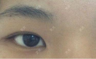 双眼皮