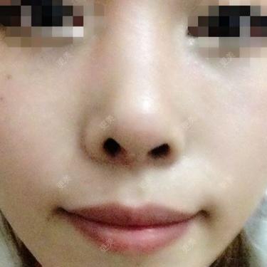 鼻部多项
