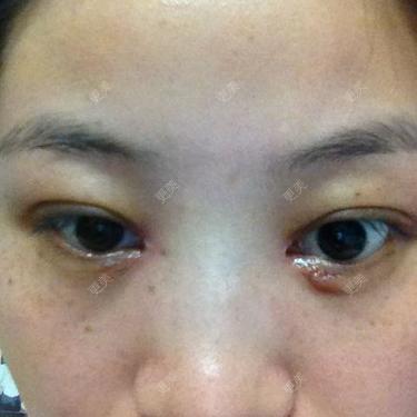 开了内眼角刚好一个月很郁闷有疤还有鼓包请问这些都能退掉吗我能用防