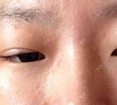 双眼皮