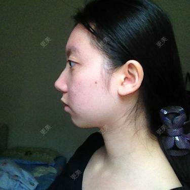 下巴也短小,额头也不怎么饱满,请问我这样的额头需要丰额吗从侧面看