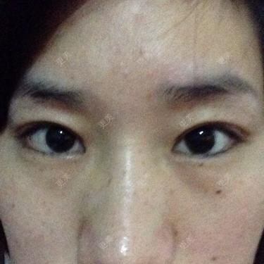 双眼皮