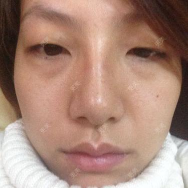 眼部其他