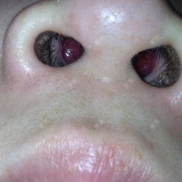 硅胶隆鼻耳软骨垫鼻尖14天了昨天晚上镜子照鼻孔里面发现有红色肉球在