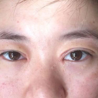 双眼皮