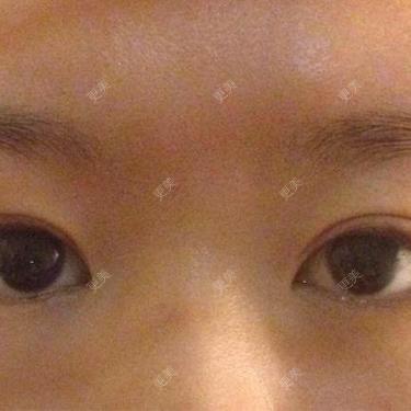 双眼皮