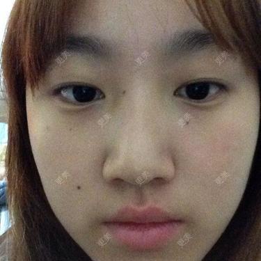 双眼皮
