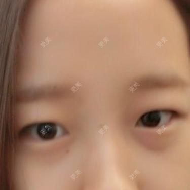 双眼皮