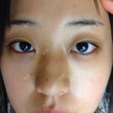 双眼皮很不明显眉眼距离大有点突眼还有肿眼泡不想开眼角不知道我适合