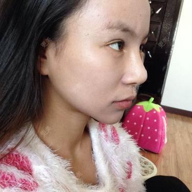 医生 我只是单纯隆鼻 本身鼻子就好看也不塌 但是我想弄成韩佳人的