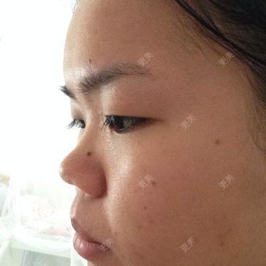 鼻子需要怎么拯救鼻子地平,鼻子短小,需要填充的量比较大,这种情况