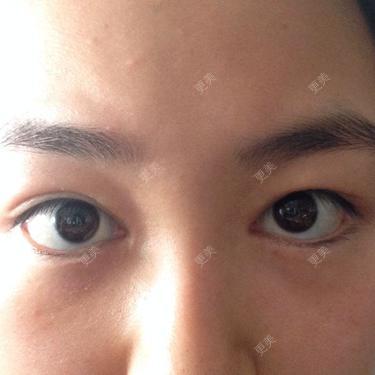 双眼皮