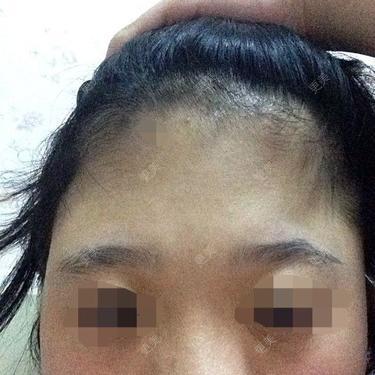 额头凹陷额头左边是塌下去的,小时候就这样,该怎么办