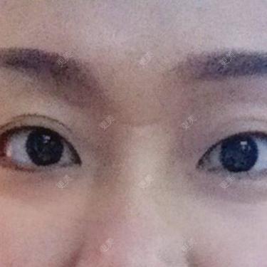 双眼皮